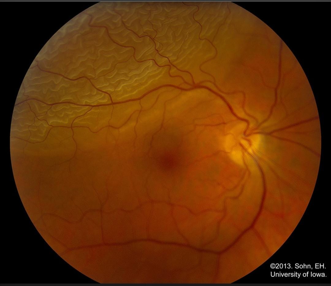 صورة B-Scan حقيقية لانفصال شبكي كلي
