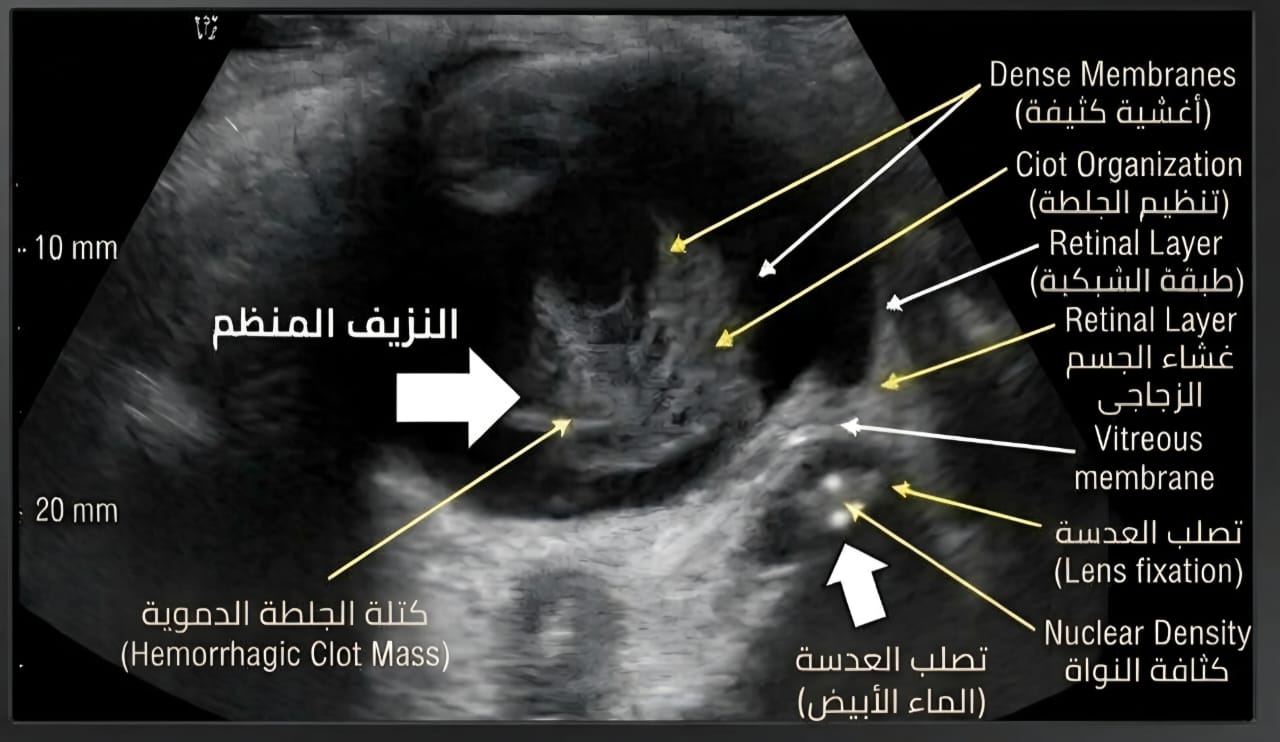 صورة B-Scan حقيقية لنزيف منظم بالجسم الزجاجي مع مياه بيضاء؛ السهم الكبير للنزيف