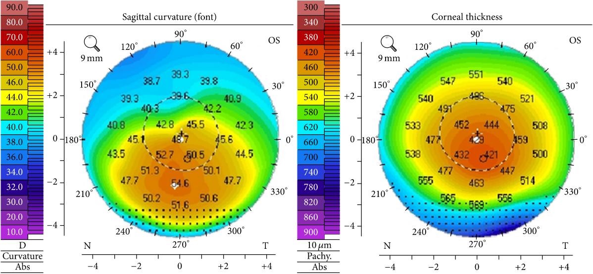 خريطة حقيقية لقرنية مصابة بالقرنية المخروطية