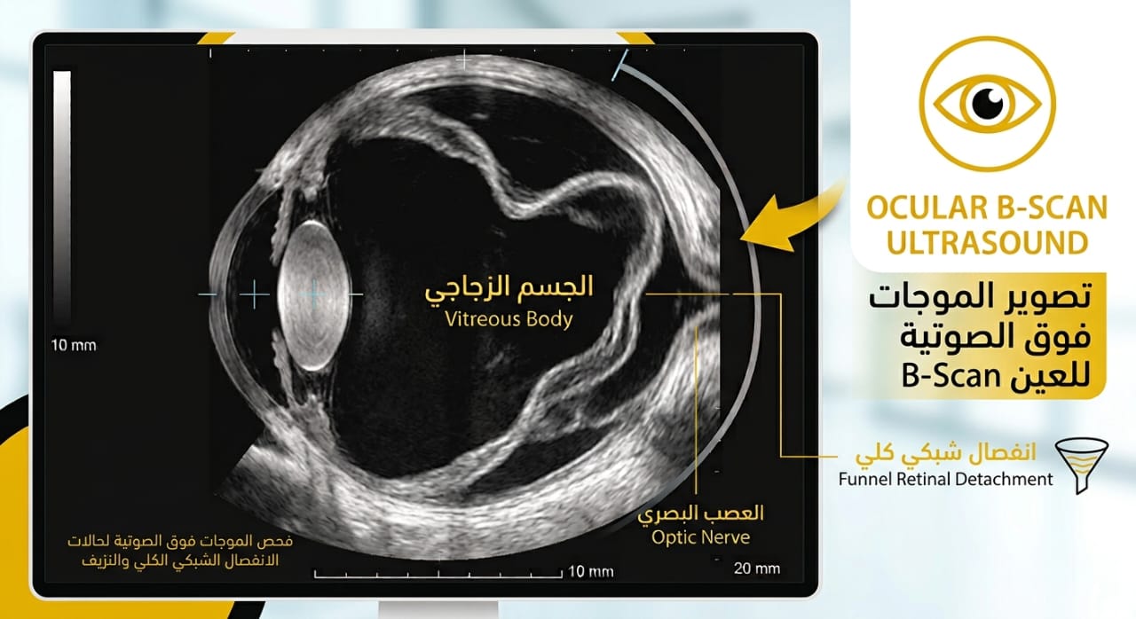 صورة B-Scan حقيقية للعين السليمة