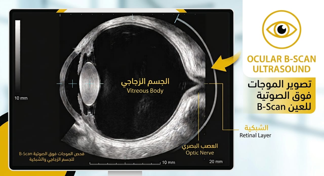 صورة B-Scan حقيقية لانفصال شبكي كلي